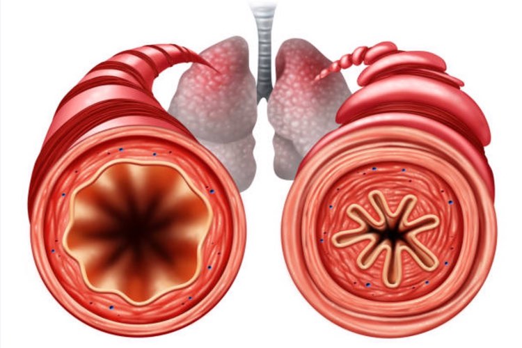 4D Pharma enters human trials for gut bacteria therapy for asthma