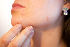 An oral treatment for acne vulgaris
