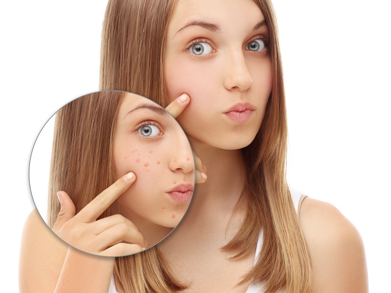 Anti-acne specialist Clearstem reworks nutricosmetic formulation for those taking antidepressants