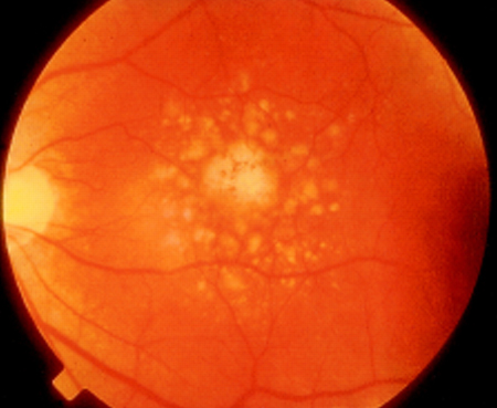 Apellis Pharmaceuticals enters clinical testing phase for age-related macular degeneration