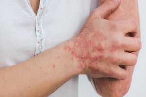 Arctic Bioscience awarded grant for herring roe psoriasis treatment