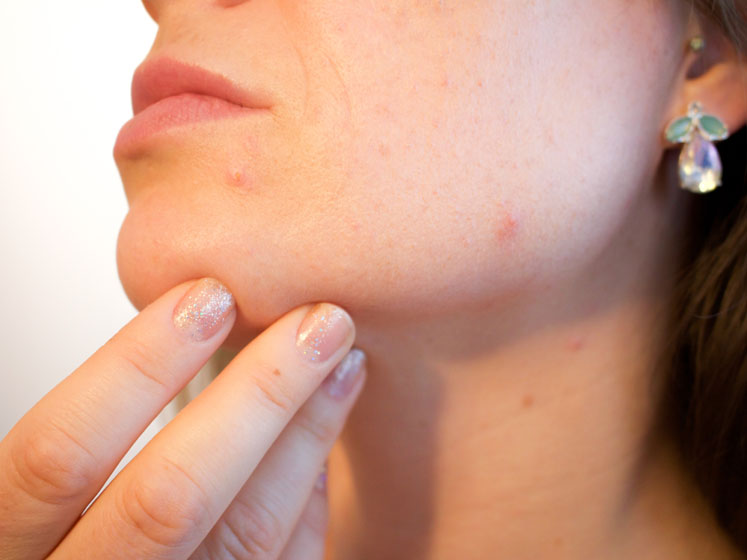 An oral treatment for acne vulgaris