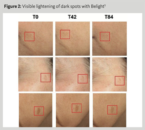 Belight3: the natural ingredient clinically proven to  reduce dark spots