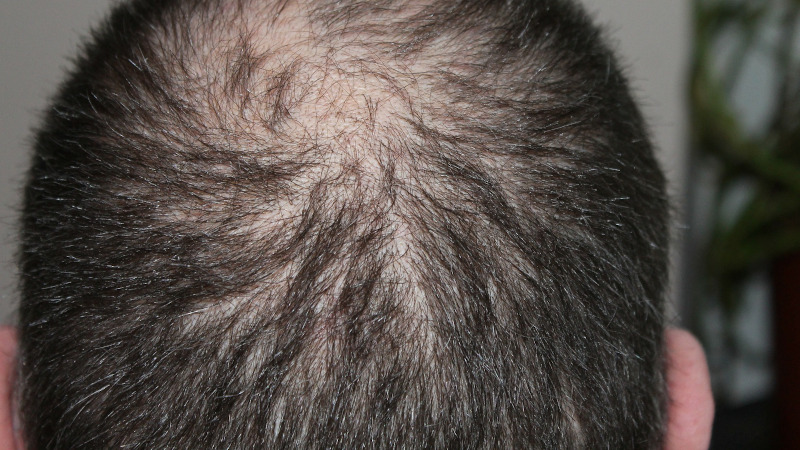 Gencor formulation shows benefits for healthy adults with hair loss