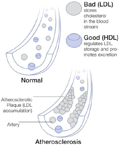 Figure 3: High LDL (low density lipoprotein) levels are a significant contributor to the occurrence of coronary heart diseases and atherosclerosis