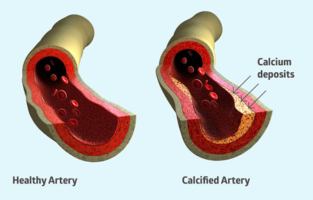 <strong>Figure 1:</strong> Vitamin K2 is essential for bone and cardiovascular health: without vitamin K2, calcium is not properly directed to bones, allowing it to build up in blood vessel walls and soft tissues