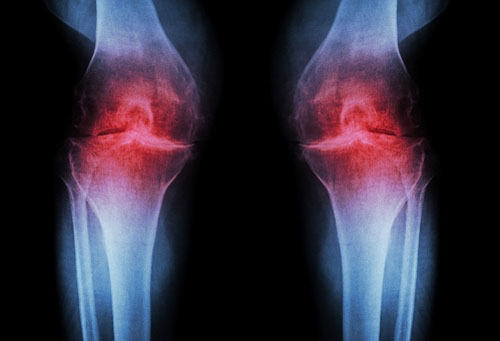 Ashwagandha decreases osteoarthritic joint pain