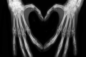 Atlanta researchers show probiotics benefits on fracture healing
