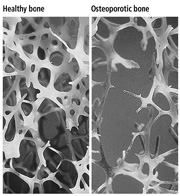 Bone health starts in the womb