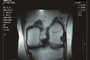 Chondroitin sulfate CS b-Bioactive delays knee osteoarthritis progression