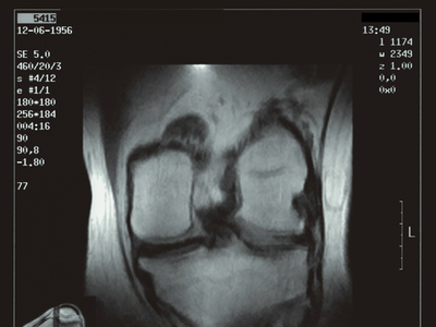 Chondroitin sulfate CS b-Bioactive delays knee osteoarthritis progression