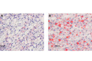 Combating childhood obesity by preventing “fatty liver” in foetus