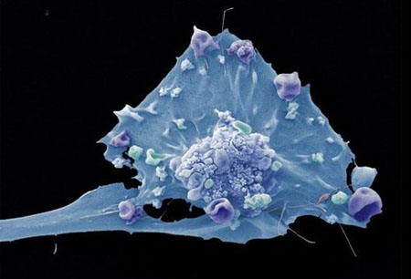New step towards breast cancer treatment by herbal compounds