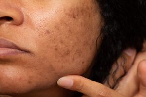 Nexira’s Oli-Ola wins Nutricosmetics Innovation Award for clinically proven dark-spot reduction