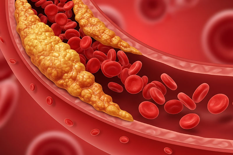 PycnoCentella: a new research-based combination ingredient for atherosclerosis (part I)