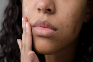 Research suggests topical probiotics may reduce acne