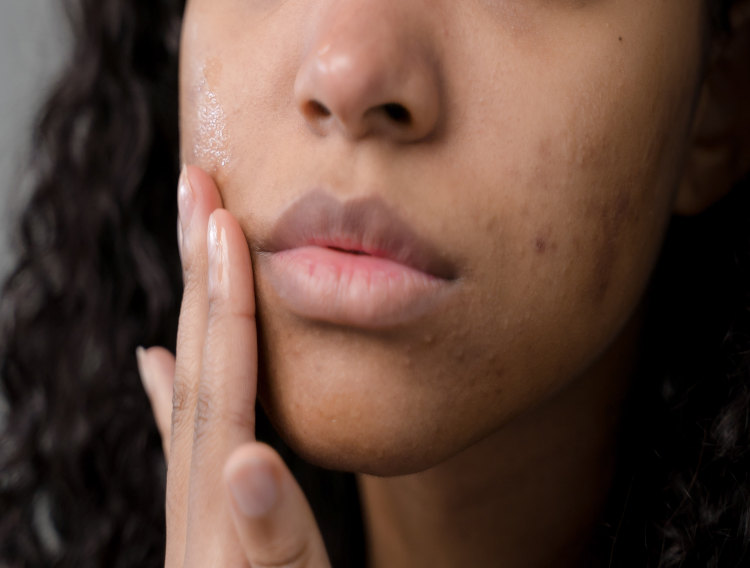 Research suggests topical probiotics may reduce acne