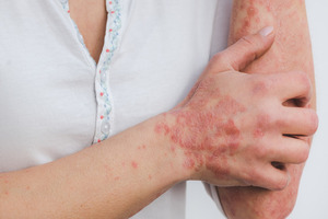 SkinBioTherapeutics supplement benefits psoriasis sufferers