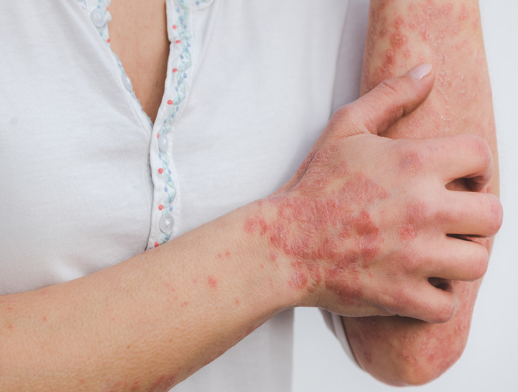 SkinBioTherapeutics supplement benefits psoriasis sufferers