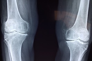 Study reveals benefits of Mythocondro on knee Osteoarthritis
