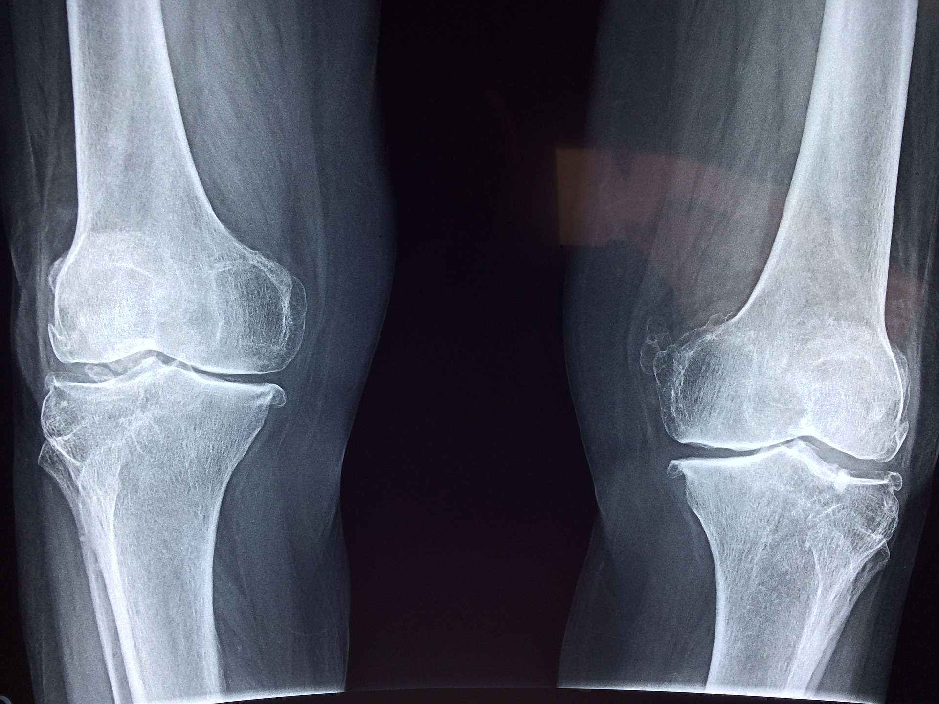 Study reveals benefits of Mythocondro on knee Osteoarthritis
