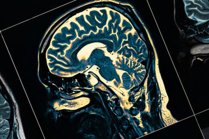 The ferroptosis frontier: the essential roles of squalene and CoQ in brain and cognitive health