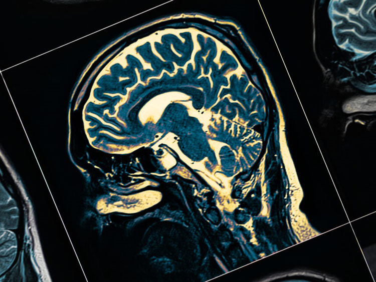 The ferroptosis frontier: the essential roles of squalene and CoQ in brain and cognitive health