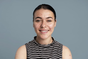 Verbasnol diminishes acne and improves skin health, study reveals