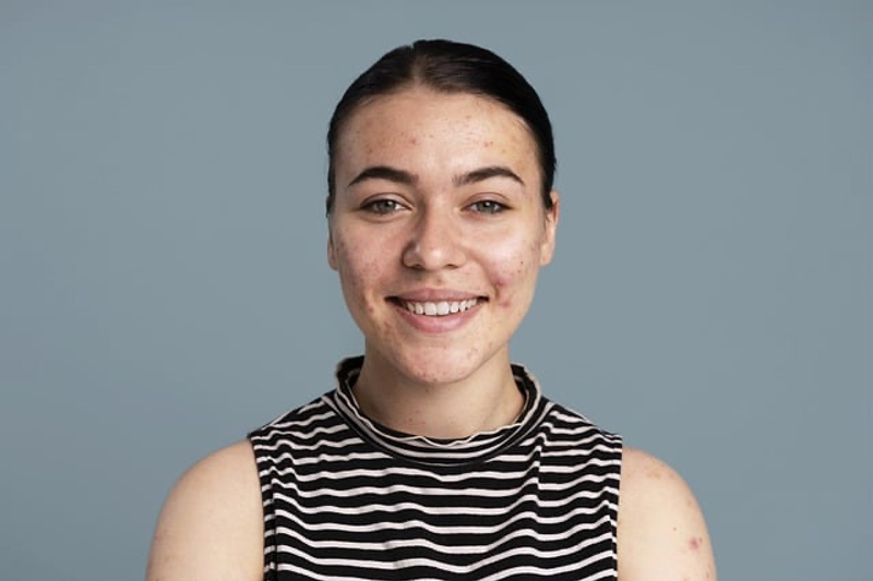 Verbasnol diminishes acne and improves skin health, study reveals