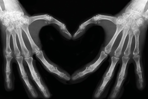Vitamin K2 MK-7 and Cardiovascular Calcification
