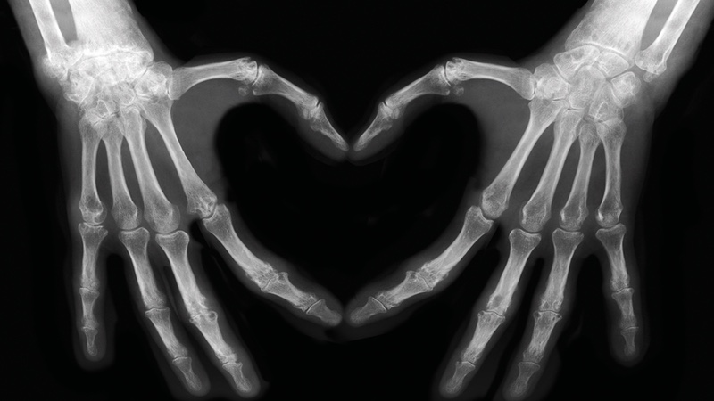 Vitamin K2 MK-7 and Cardiovascular Calcification